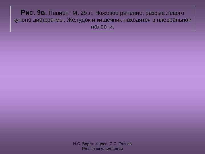  Рис. 9 в. Пациент М. 29 л. Ножевое ранение, разрыв левого купола диафрагмы.