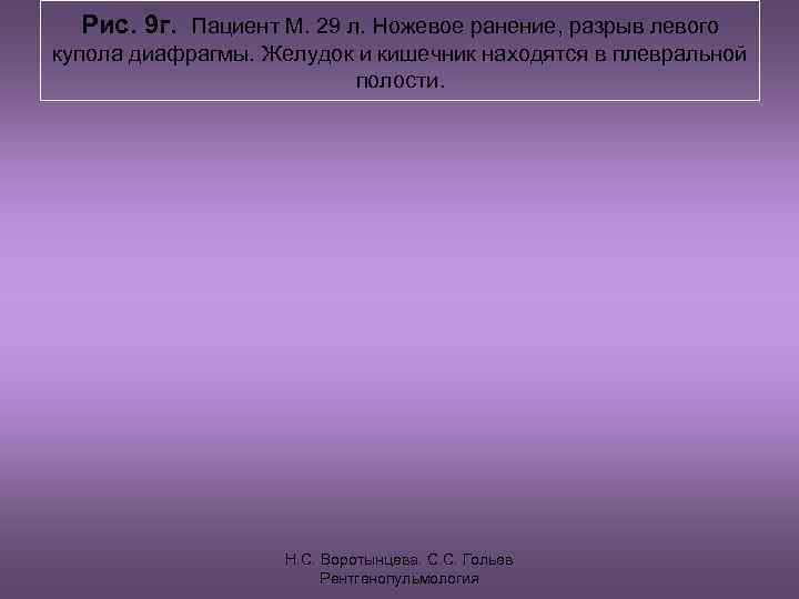  Рис. 9 г. Пациент М. 29 л. Ножевое ранение, разрыв левого купола диафрагмы.