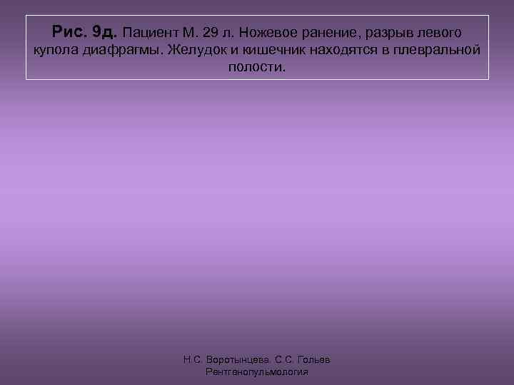  Рис. 9 д. Пациент М. 29 л. Ножевое ранение, разрыв левого купола диафрагмы.