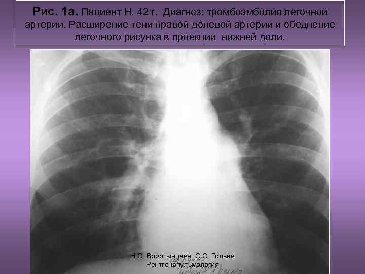  Рис. 1 а. Пациент Н. 42 г. Диагноз: тромбоэмболия легочной артерии. Расширение тени
