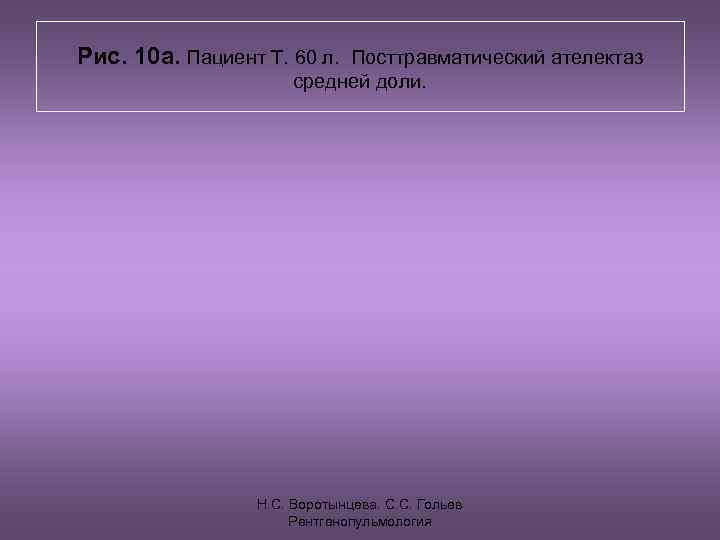 Рис. 10 а. Пациент Т. 60 л. Посттравматический ателектаз    средней доли.