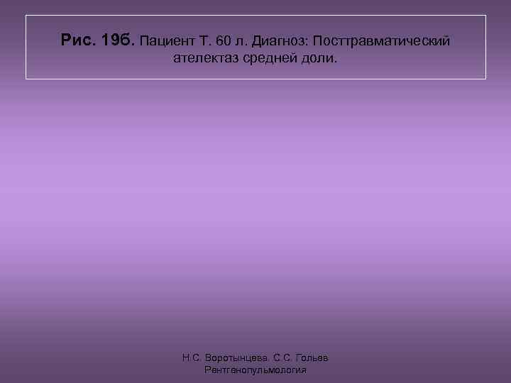 Рис. 19 б. Пациент Т. 60 л. Диагноз: Посттравматический    ателектаз средней