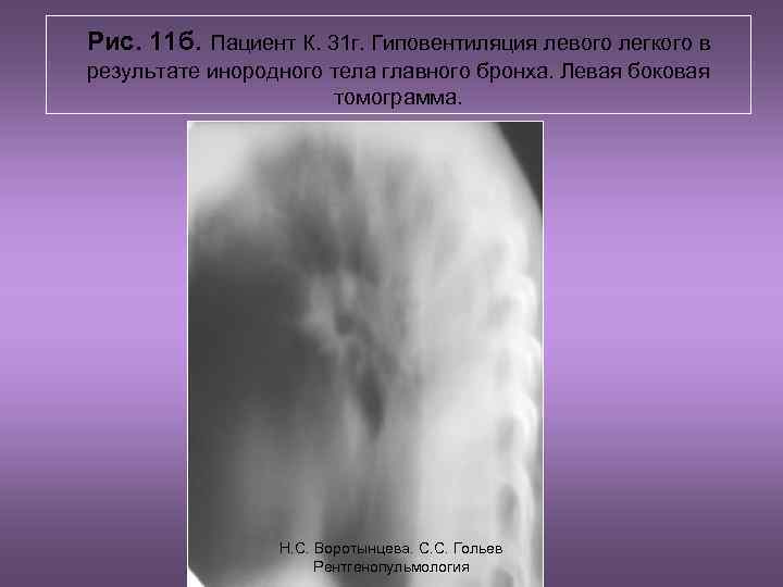 Рис. 11 б. Пациент К. 31 г. Гиповентиляция левого легкого в результате инородного тела