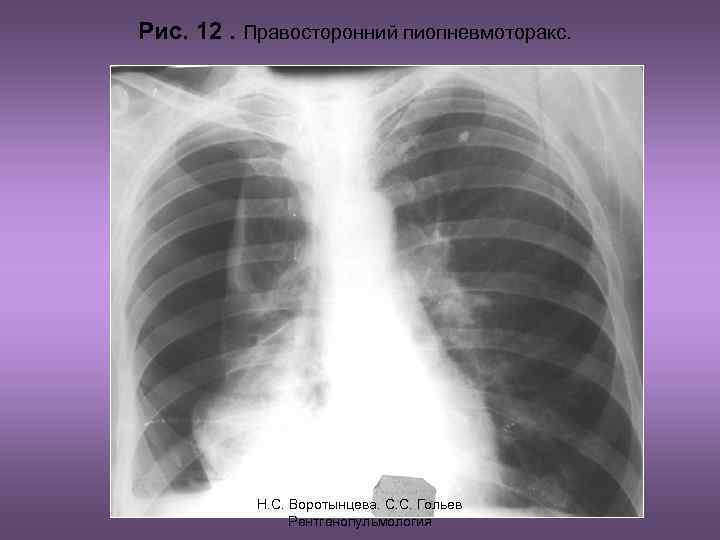 Рис. 12. Правосторонний пиопневмоторакс.   Н. С. Воротынцева. С. С. Гольев  