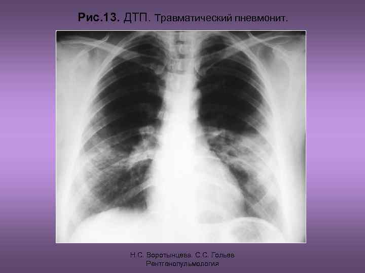 Рис. 13. ДТП. Травматический пневмонит.    Н. С. Воротынцева. С. С. Гольев