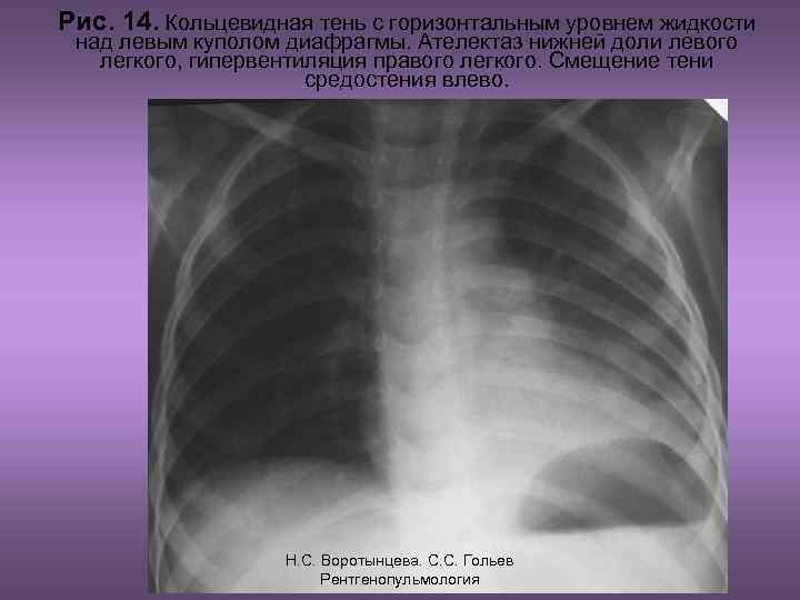 Рис. 14. Кольцевидная тень с горизонтальным уровнем жидкости над левым куполом диафрагмы. Ателектаз нижней