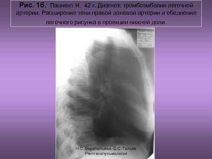  Рис. 1 б. Пациент Н. 42 г. Диагноз: тромбоэмболия легочной артерии. Расширение тени