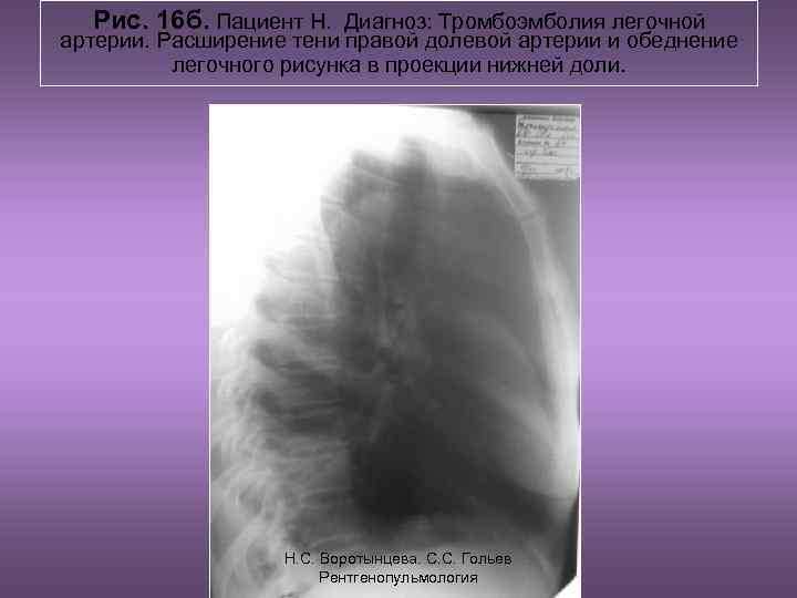  Рис. 16 б. Пациент Н. Диагноз: Тромбоэмболия легочной артерии. Расширение тени правой долевой