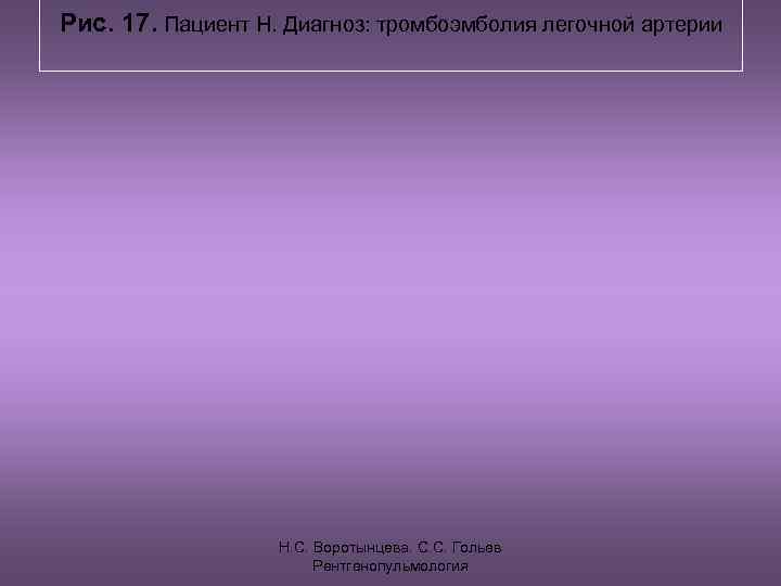 Рис. 17. Пациент Н. Диагноз: тромбоэмболия легочной артерии    Н. С. Воротынцева.