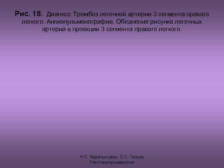 Рис. 18. Диагноз: Тромбоз легочной артерии 3 сегмента правого  легкого. Ангиопульмонография. Обеднение рисунка