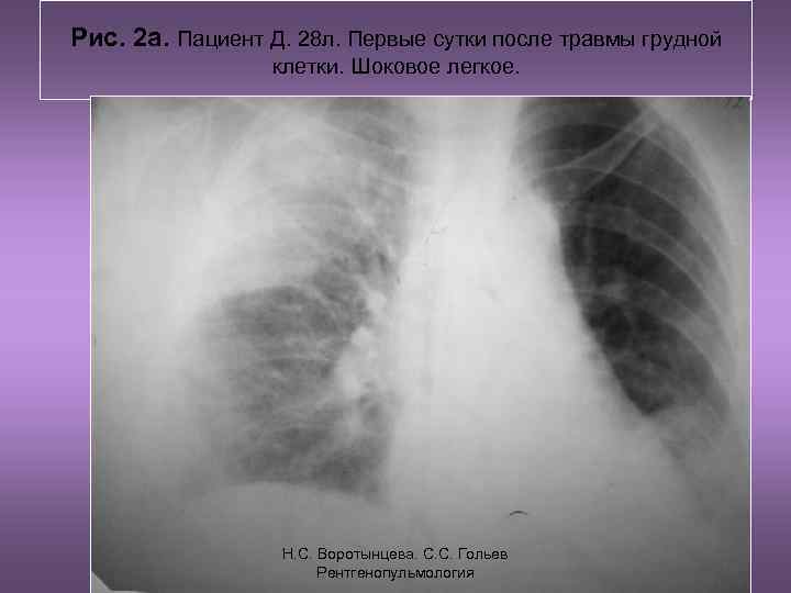 Рис. 2 а. Пациент Д. 28 л. Первые сутки после травмы грудной  
