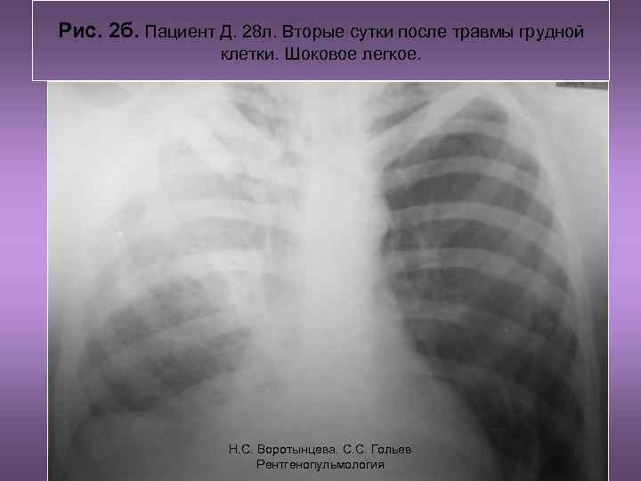 Рис. 2 б. Пациент Д. 28 л. Вторые сутки после травмы грудной  