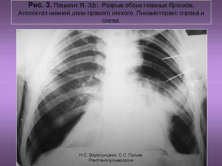   Рис. 3. Пациент Я. 32 г. Разрыв обоих главных бронхов. Ателектаз нижней