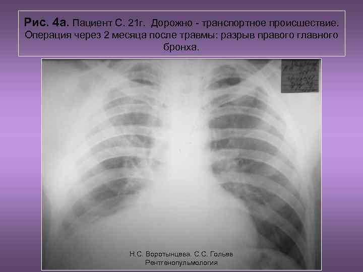 Рис. 4 а. Пациент С. 21 г. Дорожно - транспортное происшествие. Операция через 2