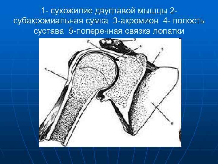   1 - сухожилие двуглавой мышцы 2 - субакромиальная сумка 3 -акромион 4