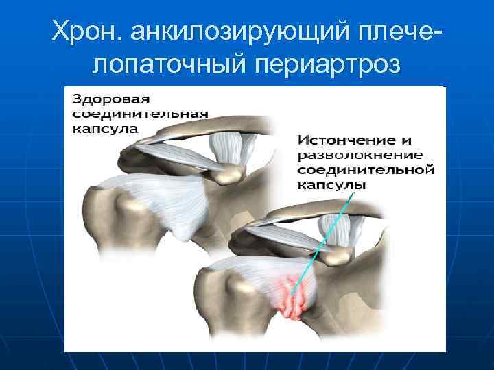 Хрон. анкилозирующий плече-  лопаточный периартроз 