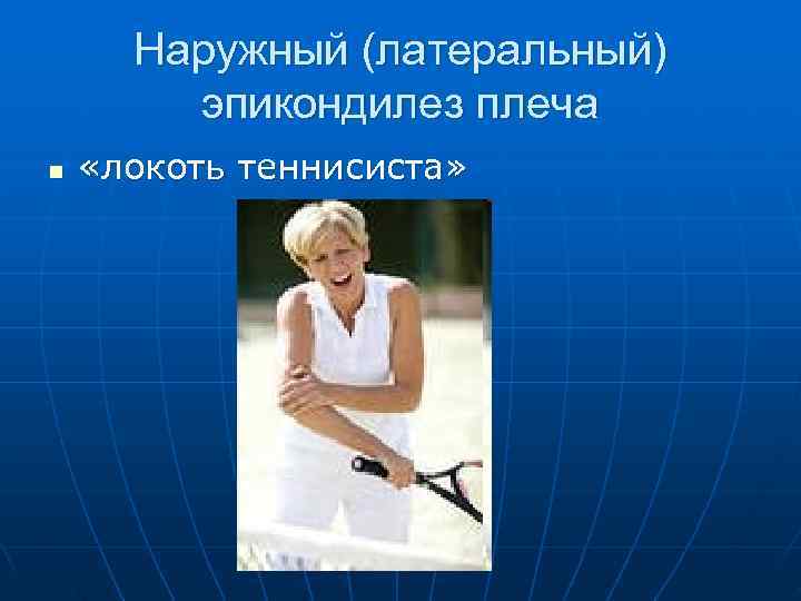  Наружный (латеральный)   эпикондилез плеча n  «локоть теннисиста» 