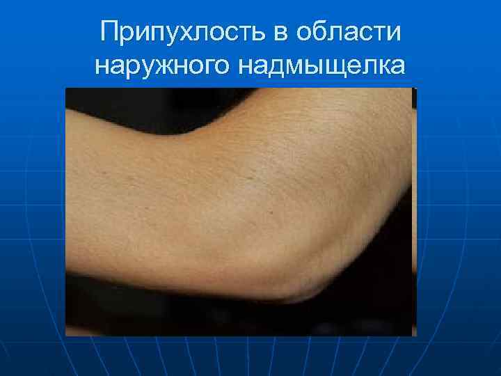 Припухлость в области наружного надмыщелка 