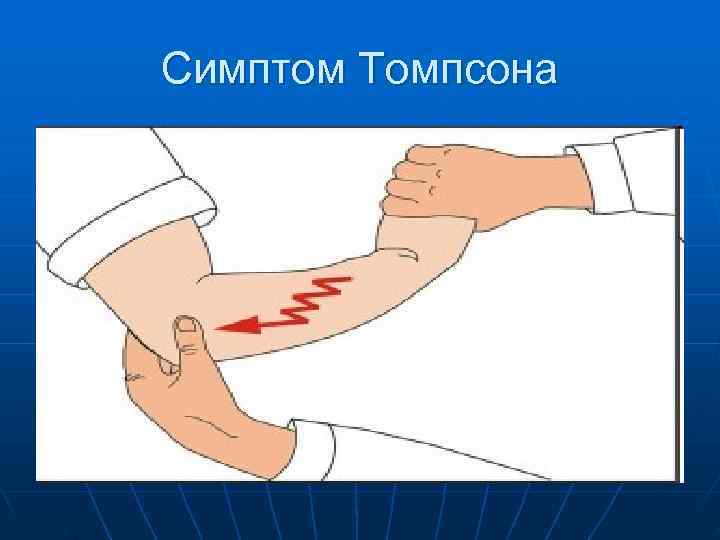 Симптом Томпсона 