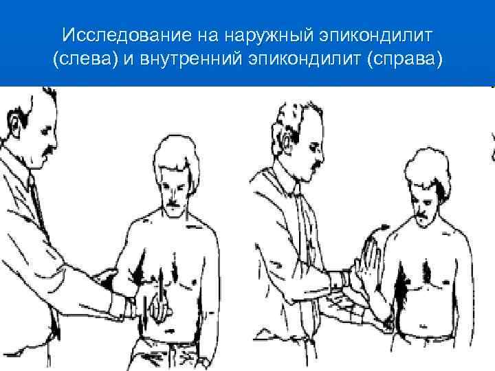  Исследование на наружный эпикондилит (слева) и внутренний эпикондилит (справа) 