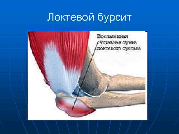 Локтевой бурсит 