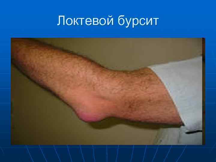 Локтевой бурсит 