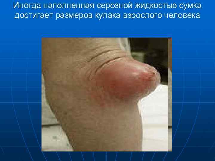 Иногда наполненная серозной жидкостью сумка достигает размеров кулака взрослого человека 