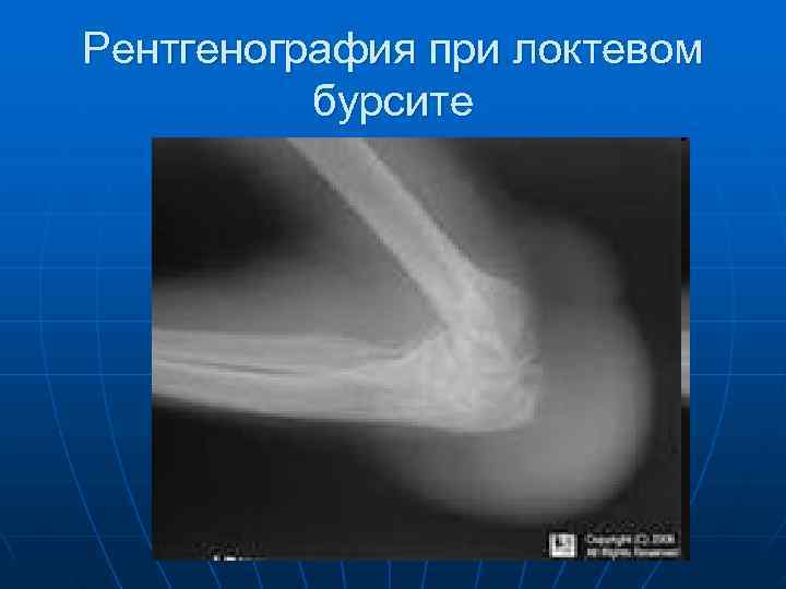 Рентгенография при локтевом  бурсите 