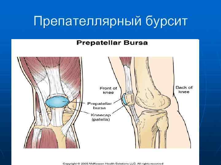 Препателлярный бурсит 