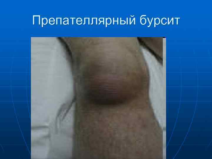 Препателлярный бурсит 