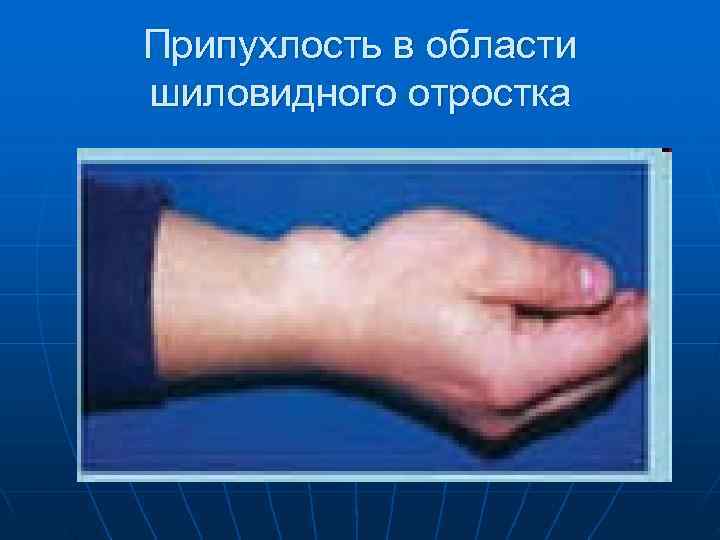 Припухлость в области шиловидного отростка 