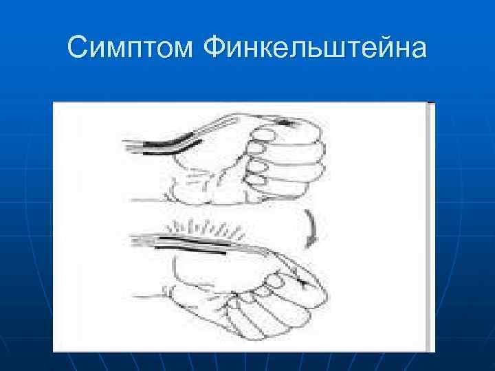 Симптом Финкельштейна 