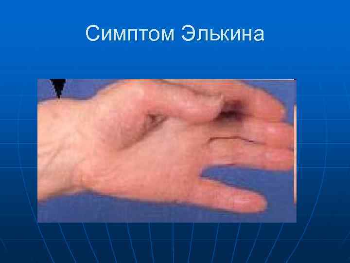 Симптом Элькина 