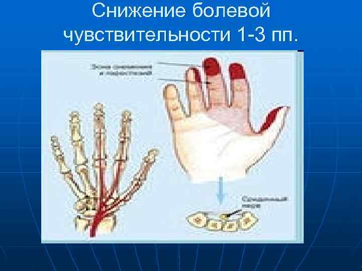   Снижение болевой чувствительности 1 -3 пп. 