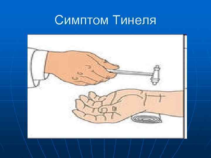 Симптом Тинеля 