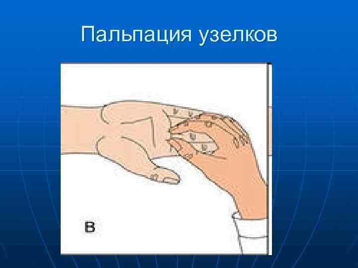 Пальпация узелков 
