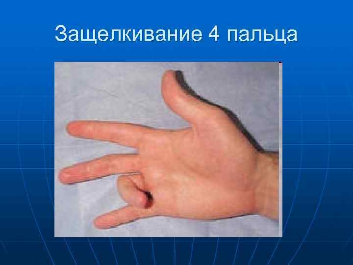 Защелкивание 4 пальца 