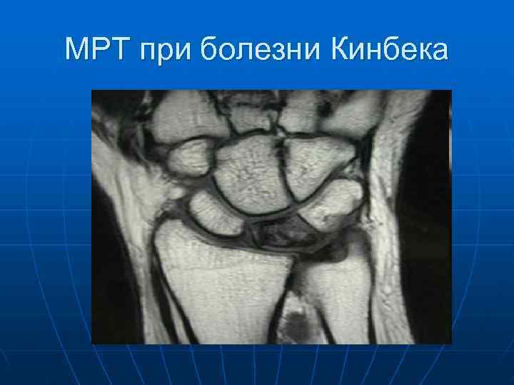 МРТ при болезни Кинбека 