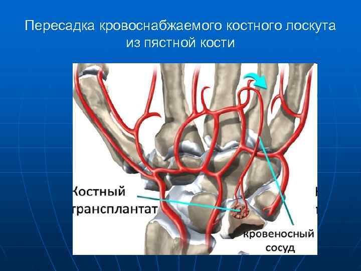 Пересадка кровоснабжаемого костного лоскута    из пястной кости 