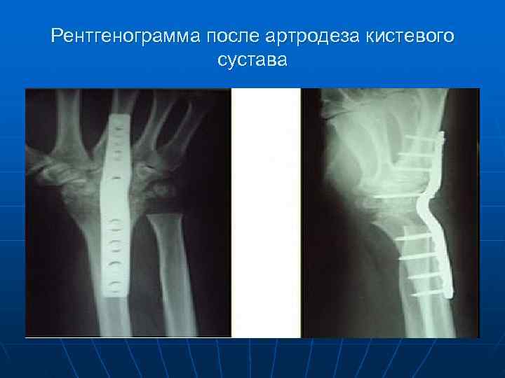 Рентгенограмма после артродеза кистевого   сустава 