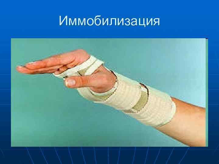 Иммобилизация 