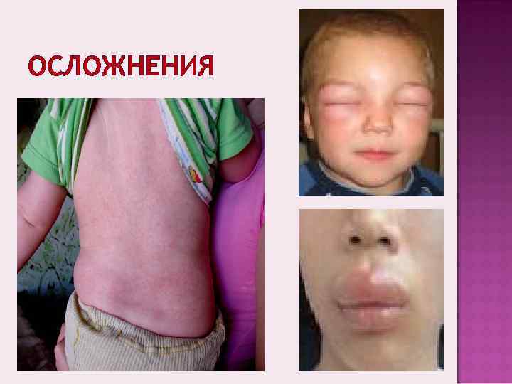 ОСЛОЖНЕНИЯ 