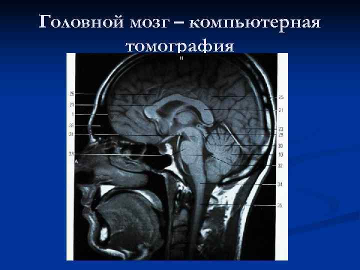 Головной мозг – компьютерная   томография 