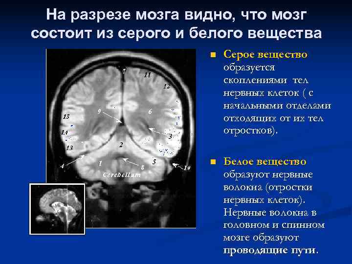  На разрезе мозга видно, что мозг состоит из серого и белого вещества 