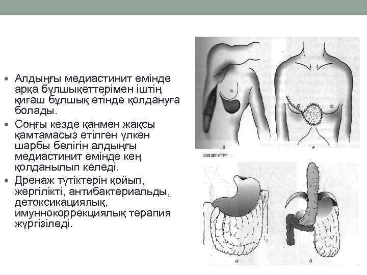  Алдыңғы медиастинит емінде  арқа бұлшықеттерімен іштің  қиғаш бұлшық етінде қолдануға 