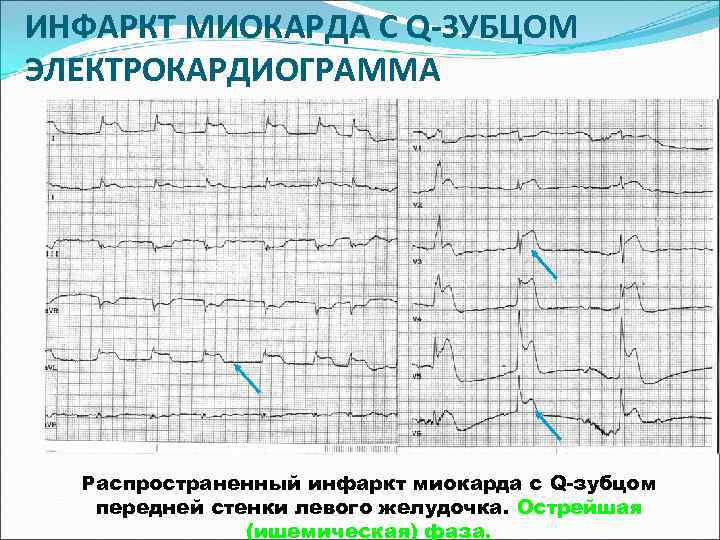 ИНФАРКТ МИОКАРДА С Q-ЗУБЦОМ ЭЛЕКТРОКАРДИОГРАММА  Распространенный инфаркт миокарда с Q-зубцом  передней стенки