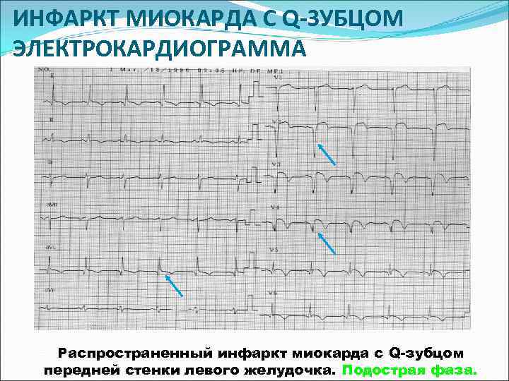 ИНФАРКТ МИОКАРДА С Q-ЗУБЦОМ ЭЛЕКТРОКАРДИОГРАММА  Распространенный инфаркт миокарда с Q-зубцом  передней стенки