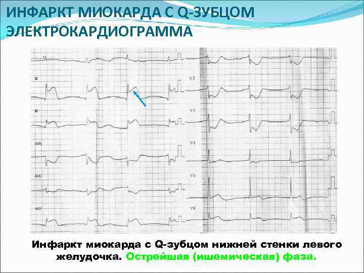 ИНФАРКТ МИОКАРДА С Q-ЗУБЦОМ ЭЛЕКТРОКАРДИОГРАММА  Инфаркт миокарда с Q-зубцом нижней стенки левого желудочка.