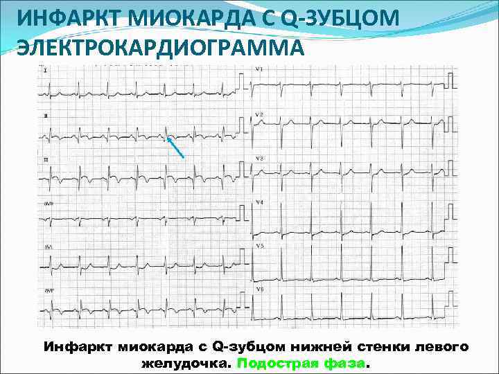 ИНФАРКТ МИОКАРДА С Q-ЗУБЦОМ ЭЛЕКТРОКАРДИОГРАММА Инфаркт миокарда с Q-зубцом нижней стенки левого  желудочка.