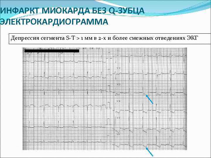 Экг депрессия сегмента